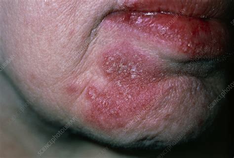 Facial Rash Of Systemic Lupus Erythematosus Sle Stock Image M200