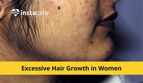 Excessive Hair Growth In Women Hirsutism Treatment And Causes