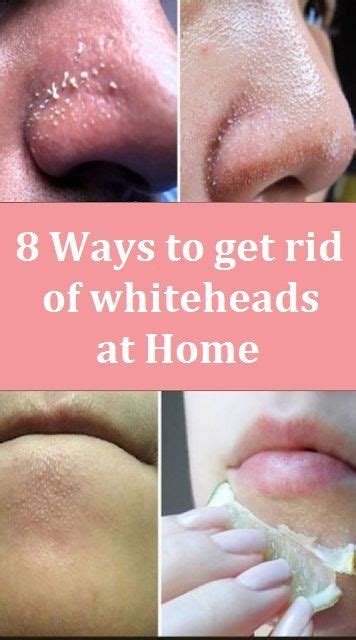 8 Ways To Get Rid Of Whiteheads At Home In 2020 Dry Skin On Face
