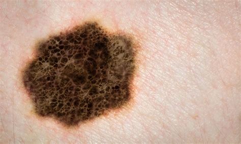 Skin Cancer And Sun Damage Jh Skincare Clinic Ipl Laser