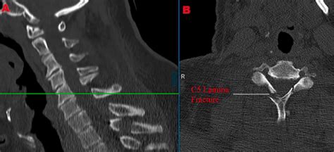 Ct Scan Lamina Fracture And Spinous Process Fracture In A Subject