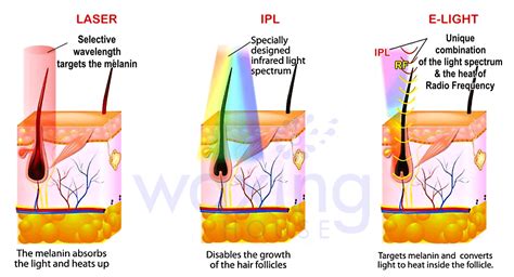 Diode Laser Vs IPL Hair Removal Diode Laser And IPL Are Both Excellent Methods Of Hair Removal