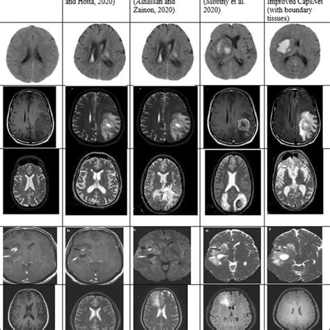 Sample Classification Outcomes Of The Brain Mri Images With Nn Fcnn