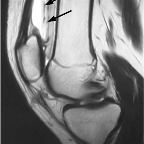 Pdf Knee Hemarthrosis After Arthroscopic Surgery In An Athlete With