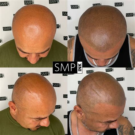 Scalp Micropigmentation Before And After Photos Smp Ink
