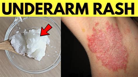 Try This Remedy To Heal Underarm Armpit Rash From Natural Deodorant