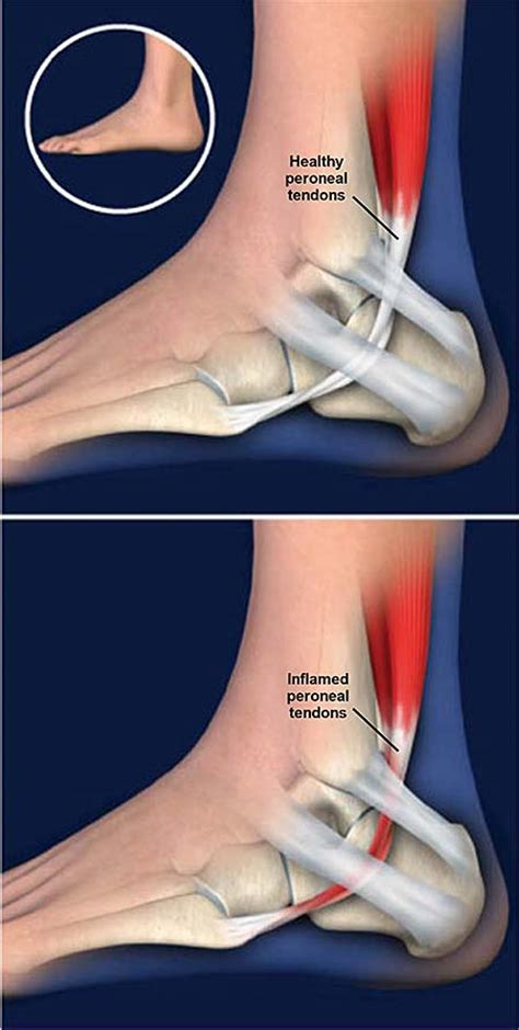 Peroneal Tendonitis Tendinitis Is Inflammation Of The Peroneal Hot Sex Picture