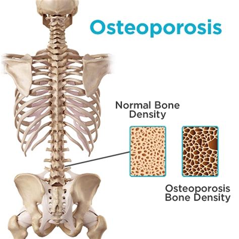 The bones of the back, together, make up the vertebral column. Scoliosis and Osteoporosis