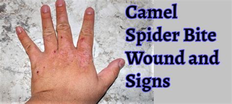 Camel Spider Bite Symptoms And Treatment Symptomsclinic