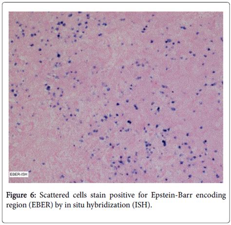 Ebv Positive Plasmablastic Lymphoma Mimicking Reactive Lymphadeno