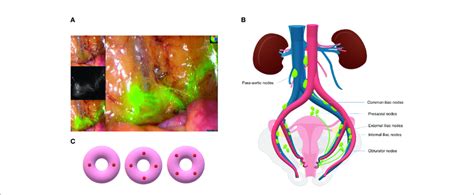 A Sln And Lymphatic Vessel Mapped In Surgery Using Icg Dye