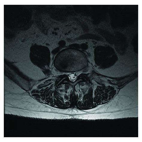 Pdf Synovial Cyst Mimicking An Intraspinal Sacral Mass
