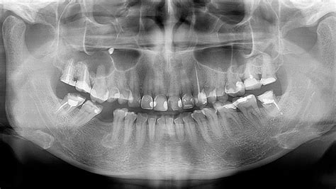 Panoramic Radiograph Steele Dental Southern Illinois Dentistry In