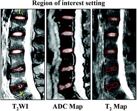Mr Imaging Assessment Of Lumbar Intervertebral Disk Degeneration And