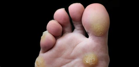 Types Of Foot Corn And How To Get Rid Of Them