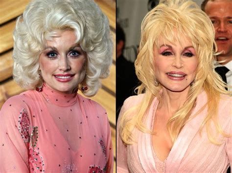 Dolly Parton Plastic Surgery Before and After Breast ...
