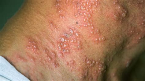 Shingles Overview Symptoms Causes Treatment And More Everyday Health