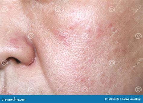 Allergy Rash On The Face Stock Photo Image Of Hives 166265422