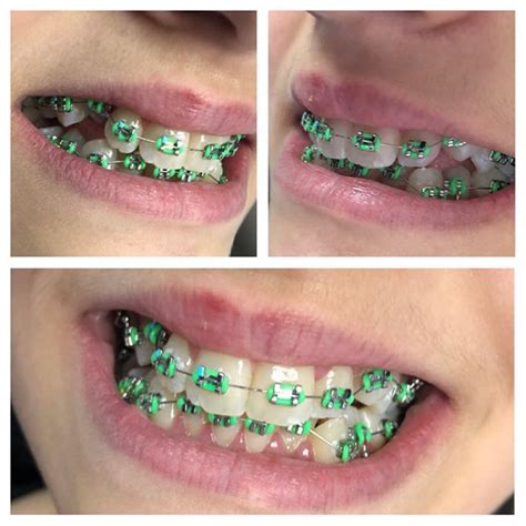 How Green Braces Are Perfect Choice For Your Teeth Braces Explained