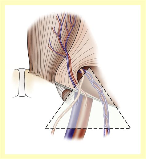 Hernia Symptoms Male Groin : Laparoscopic inguinal hernia 