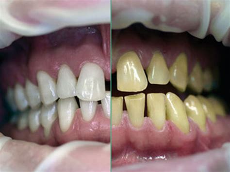 Schöne und gesunde zähne spielen eine wichtige rolle für ihr wohlbefinden, ihre ausstrahlung und ihre lebensqualität. Zahnaufhellung - Bleaching - Dental BlogDental Blog