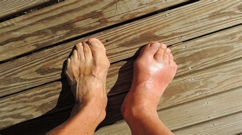 Bunions Causes Symptoms Diagnosis Treatment And Prevention