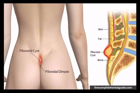 How To Get Rid Of A Pilonidal Cyst Without Surgery