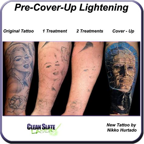 Clean Slate Tattoo Removal Home Design Ideas