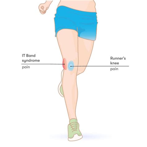 Runners Knee Itb Symptomer Behandling Og Trening