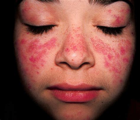 Lupus Rash On Face Pictures Medical Pictures And Images 2021 Updated