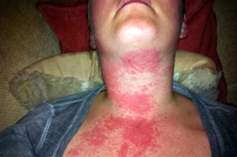 Severe Allergic Reaction To Amoxicillin Allergic Reaction Allergic