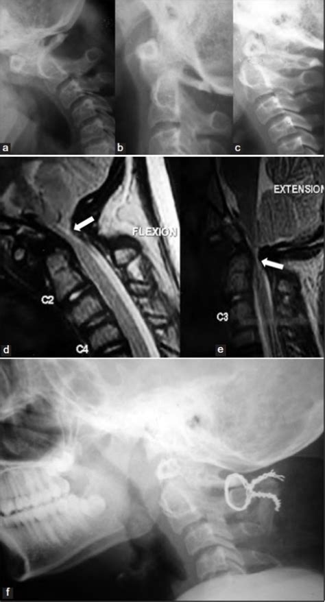 Plain Lateral Radiographs Of Craniovertebral Junction I Open I My Xxx