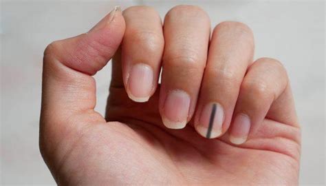 Womans Warning Goes Viral After Finding Out Curved Fingernails Are A