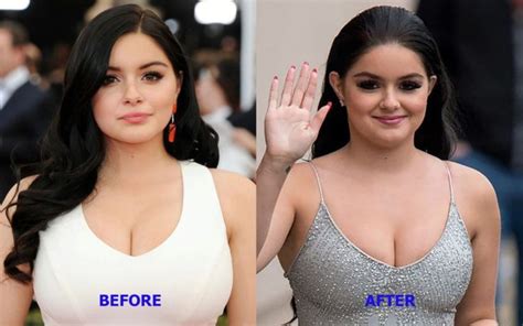 Pin On Breast Reduction