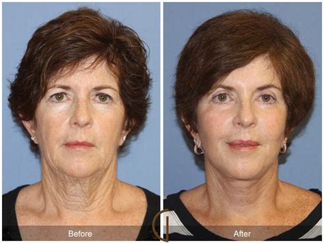 Neck Lift Before And After Photos Patient 29 Dr Kevin Sadati