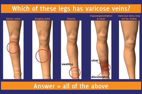 Q Which Of These Legs Has Varicose Veins A All Of Them Varicose