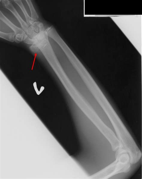 Salter Harris Fracture Type I Radiology Cases