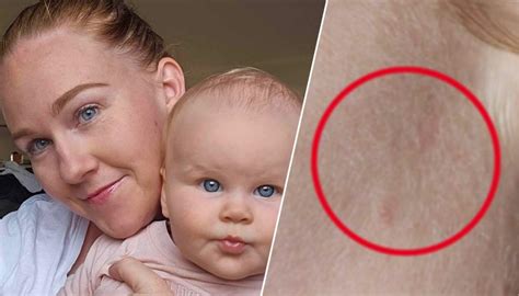 Aussie Mums Warning After Stubborn Spot Dismissed As Nothing By Gps