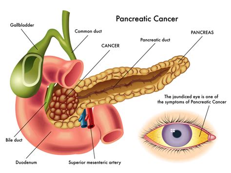 What are the symptoms of pancreatic cancer? 6 Early Warning Signs Of Pancreatic Cancer You Should Know ...