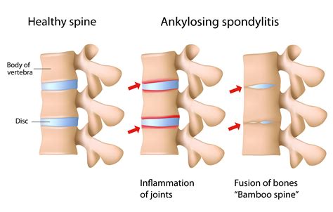 Ankylosing Spondylitis Causes Symptoms Treatments