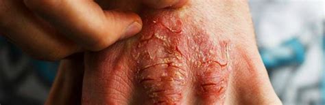 Dermatitis Atópica Conoce Sus Síntomas Y Cómo Tratarlo