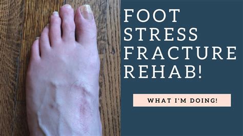 Exercise With Stress Fracture In Foot Online Degrees