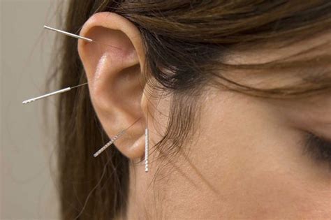 Auriculotherapy Ear Acupuncture 101 What Is Good For