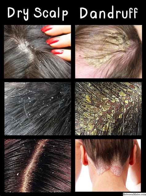 Dandruff Vs Dry Scalp Causes Treatment And Differences Hairstory Porn