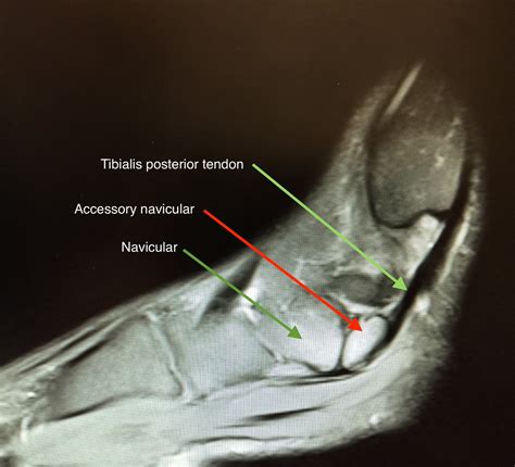 Posterior Tibial Tendon Mri