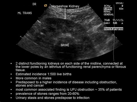 Exported Horseshoe Kidney