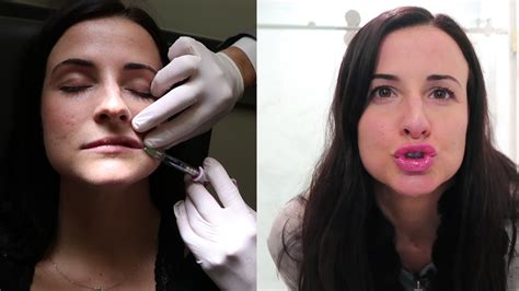 The Truth Behind Lip Fillers Tasteful Or Tacky Glam Lab Abc7 New York
