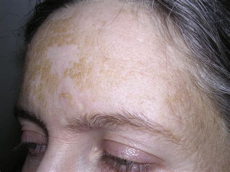 Dermatosis Neglecta A Series Of Case Reports And Review Of Other Dirty