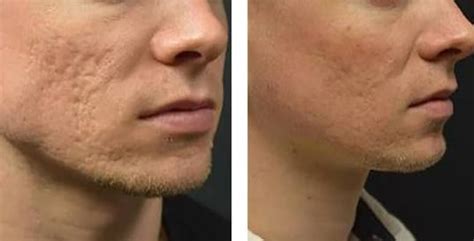 Microneedling For Acne Scars Acne Scar Treatment In Andheri West Mumbai