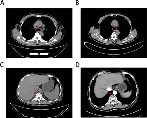 The Chest And Abdominal Computed Tomography Ct A Revealed Bilateral